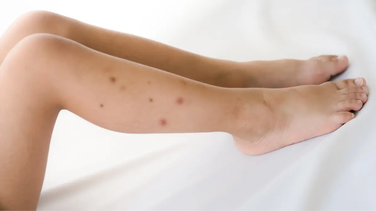 Piqure De Puce Comment La Reconnaitre Et La Soulager SANIPURE Piqure De Puce Comment La Reconnaitre Et La Soulager SANIPURE