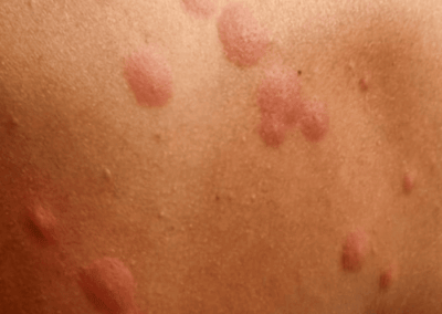 grosses piqures punaise de lit