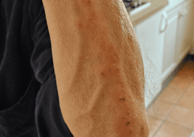 photo piqure punaise de lit personne agée
