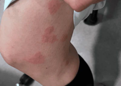 piqure punaise de lit cuisse