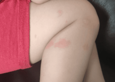 piqure punaise de lit cuisse enfant