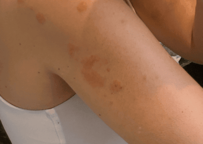 piqure punaise de lit epaule de femme