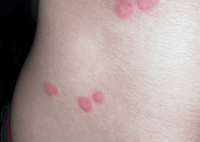 piqure punaise de lit rouge