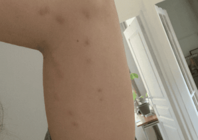 piqure punaise de lit sous le bras