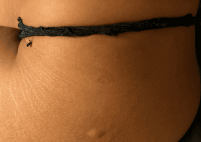 piqure punaise de lit sur fesse