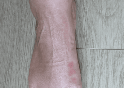 piqure punaise de lit sur pieds